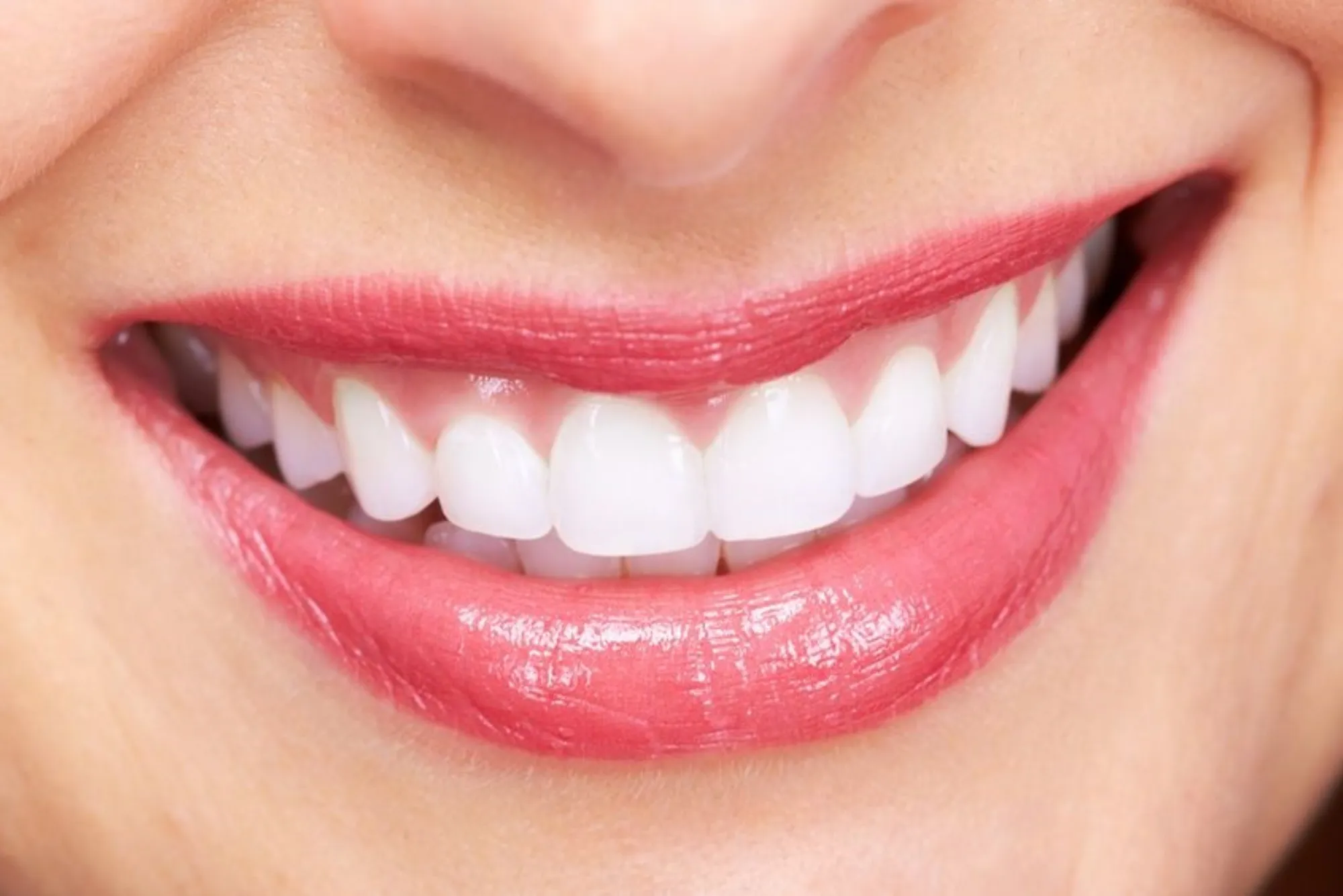 Veneers In Dubai